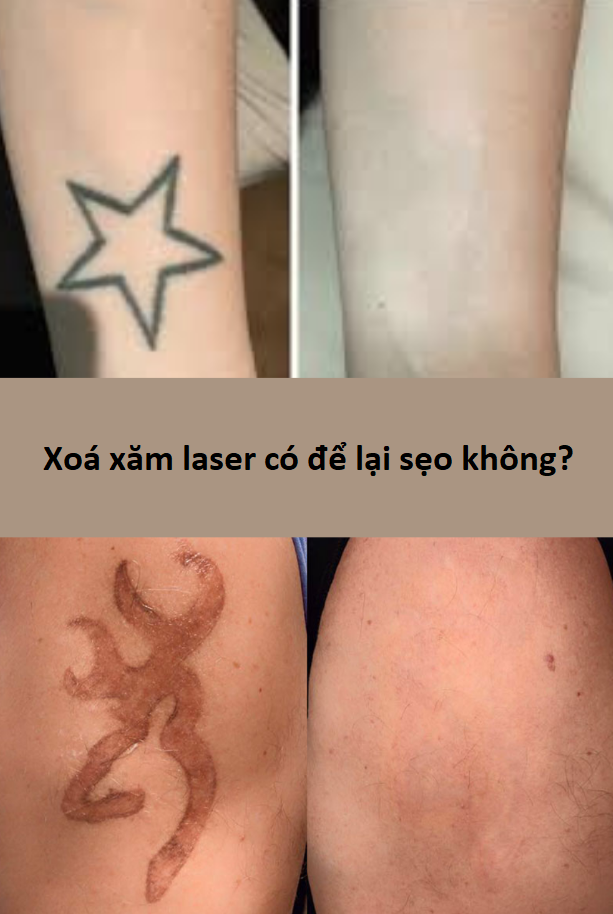 Xóa hình xăm không để lại sẹo bằng laser  Thu Cúc Sài Gòn