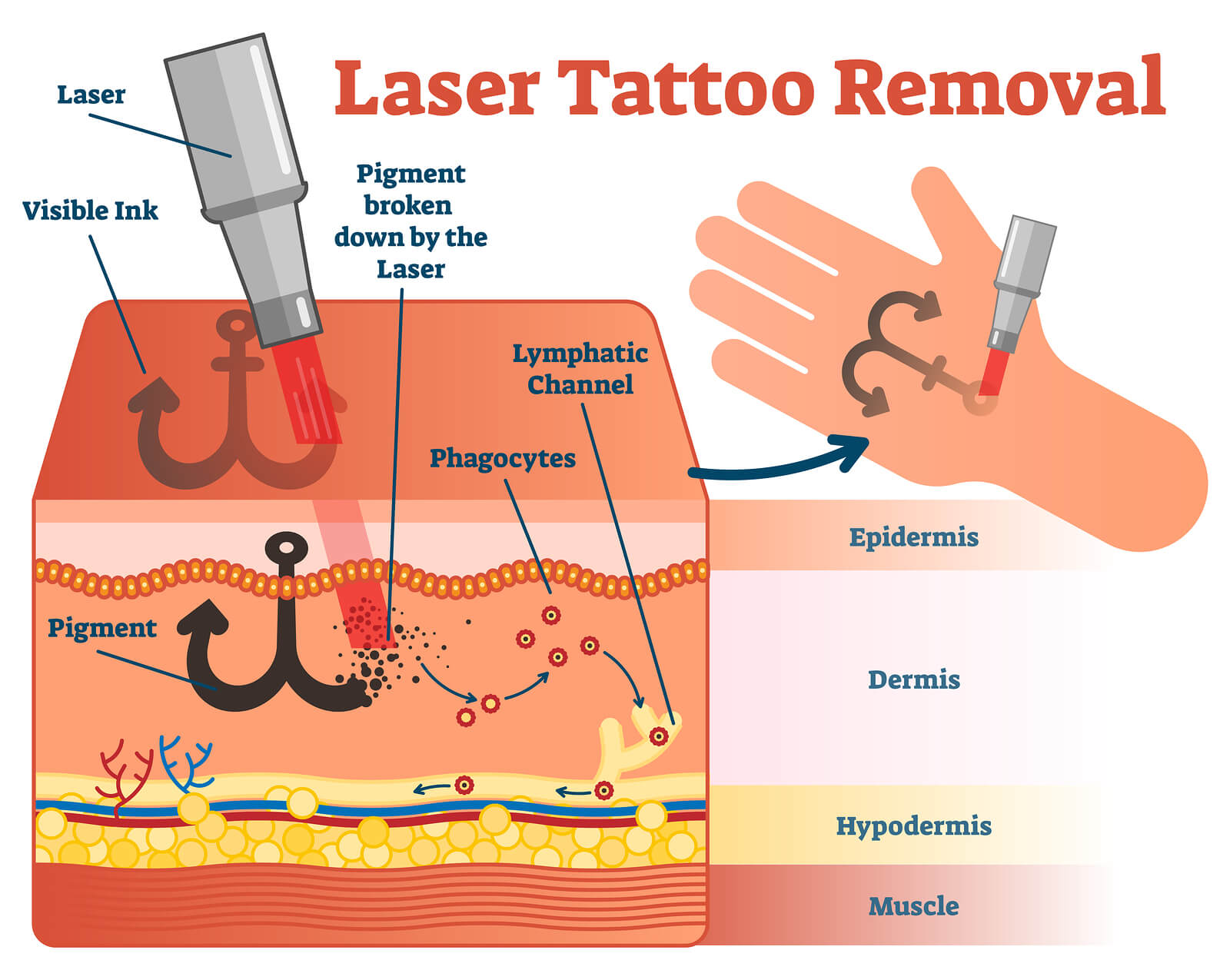 Máy laser xoá hình xăm hoạt động như thế nào